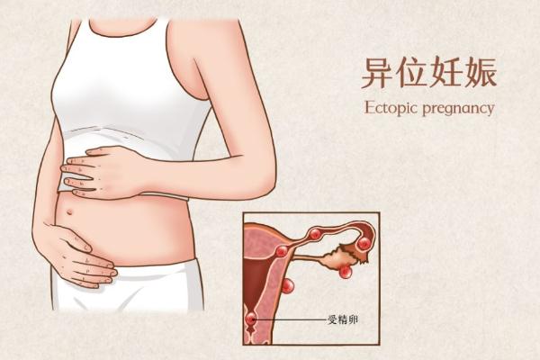 宫外孕的症状有哪些表现 宫外孕怎么办处理方法